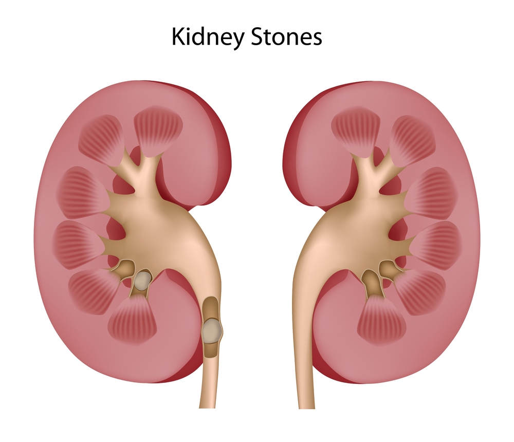 http://allinallnews.com/wp-content/uploads/2014/10/Kidney-Stones.jpg