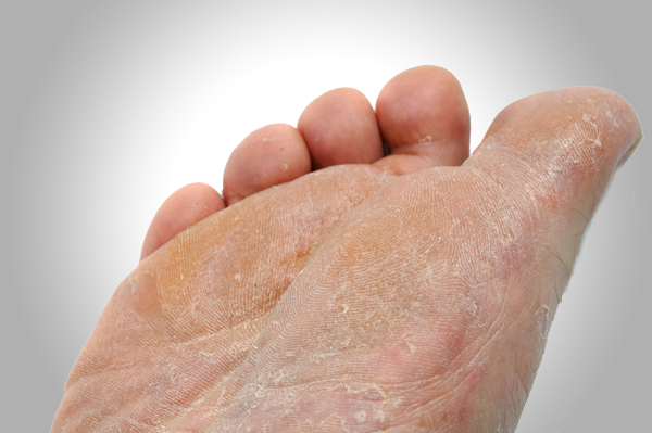 skin rashes on foot