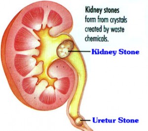 kidney Stone Problem