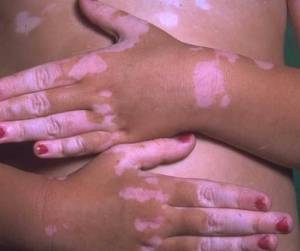 Precautions against Vitiligo
