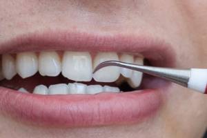 How to remove tooth tartar at home 