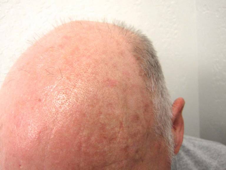 Actinic Keratosis Description Cause Symptoms And Treatment