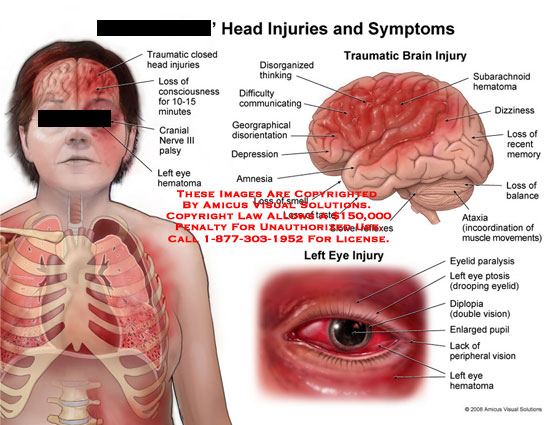 Eye Injuries from Head Trauma