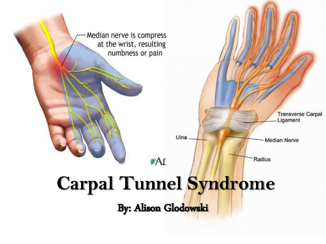 Carpal Tunnel Syndrome – Definition and Treatment - All in All News