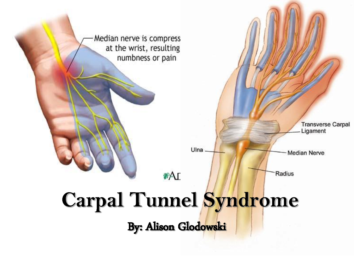 carpal tunnel pain