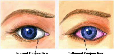 Infections We Can Get from Improper Use of Contact Lenses