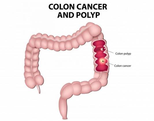 Colon Cancer Meaning In English